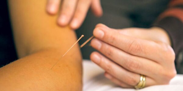 Acupuncture & IMS service photo